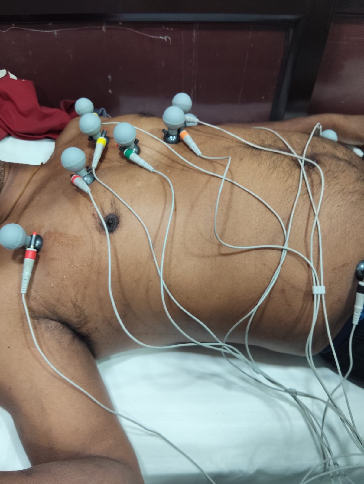 ECG electrodes placed on a patient's chest during a heart rhythm test at 360 Clinics.